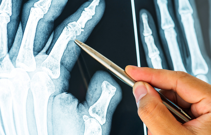 radiografía de mano para diagnóstico médico radiografía de la mano para análisis óseo, diagnóstico y cirugía